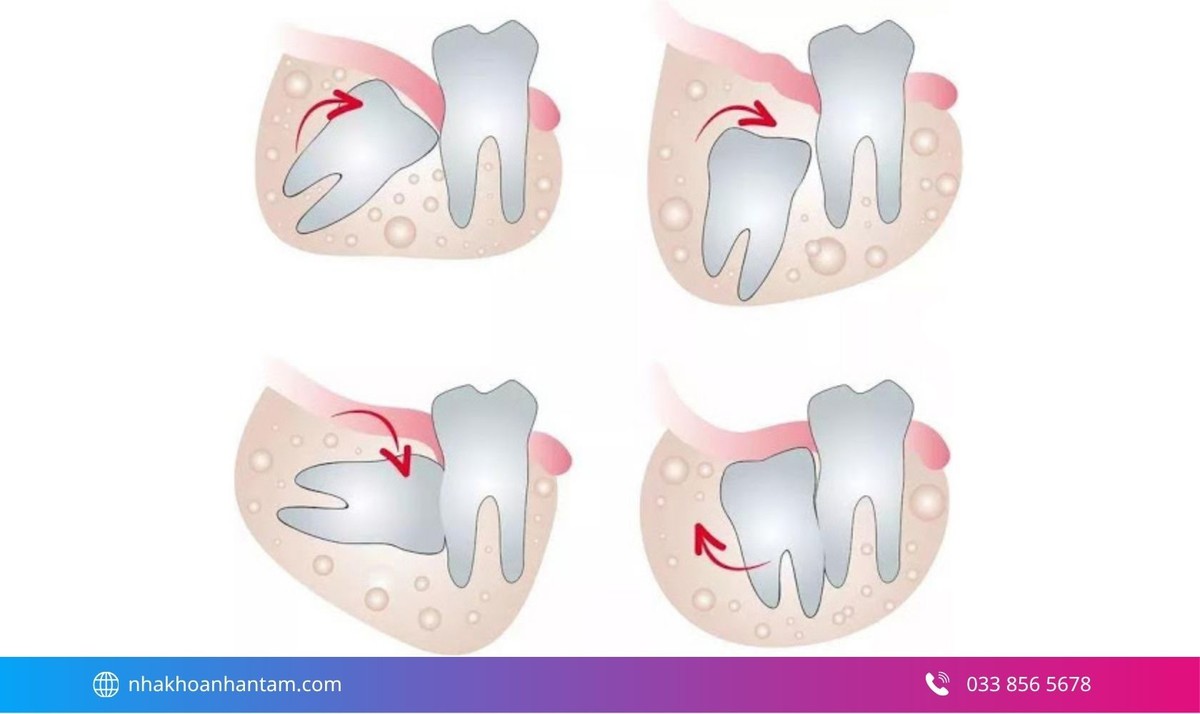 Hình: Răng khôn mọc lệch hoặc mọc ngầm gây nhức đầu