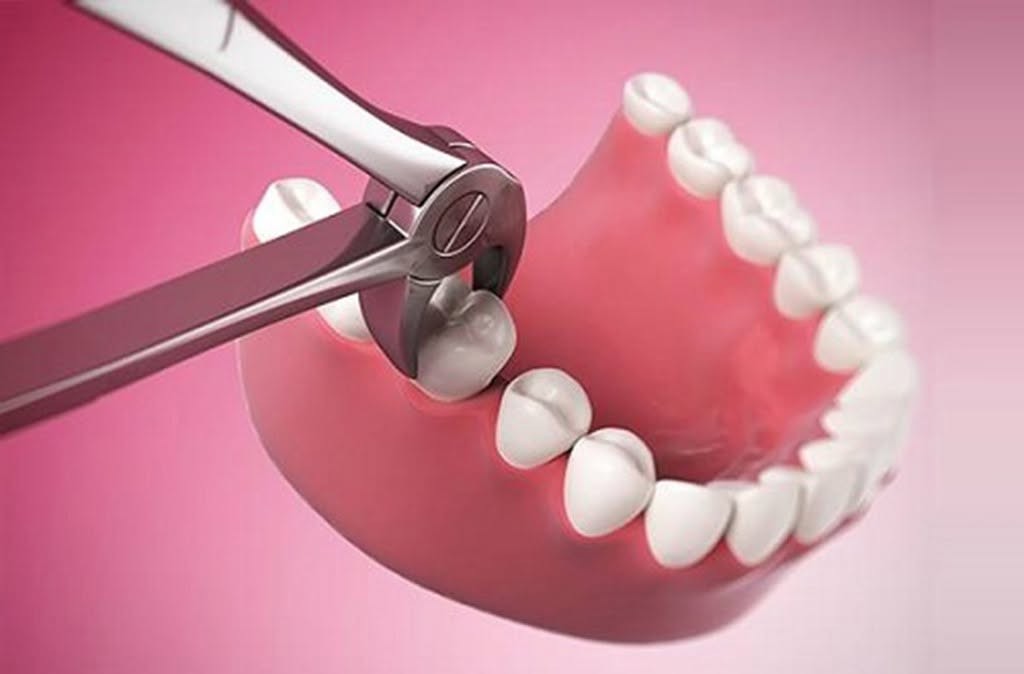 Hình: Vị trí răng khôn sâu tiềm ẩn nguy cơ gây hư hại răng số 7 kế cận