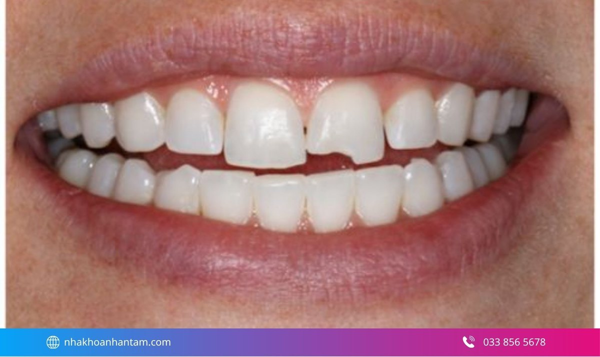 Răng bị mẻ nhẹ có thể phục hồi bằng vật liệu trám Hình: Răng bị mẻ nhẹ có thể phục hồi bằng vật liệu trám