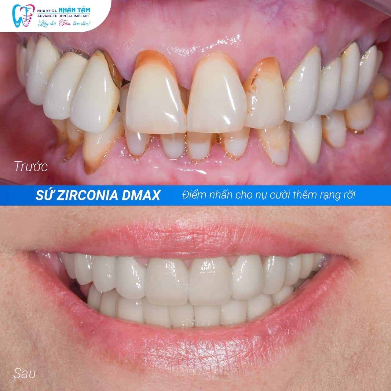 Răng Sứ Bị Vỡ Gây Mất Thẩm Mỹ Phải Làm Sao? Răng Sứ Bị Vỡ Gây Mất Thẩm Mỹ Phải Làm Sao?