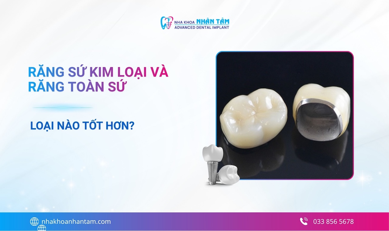 Răng sứ kim loại và răng toàn sứ: Loại nào tốt hơn?