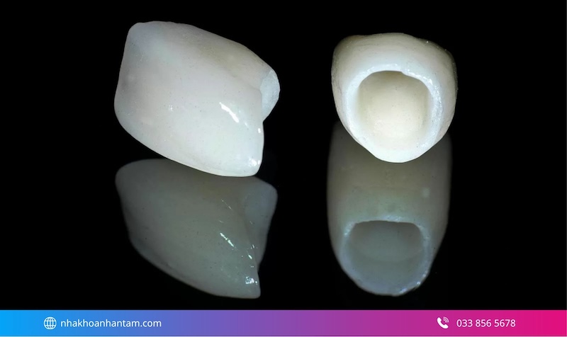 nên chọn răng sứ kim loại hay toàn sứ