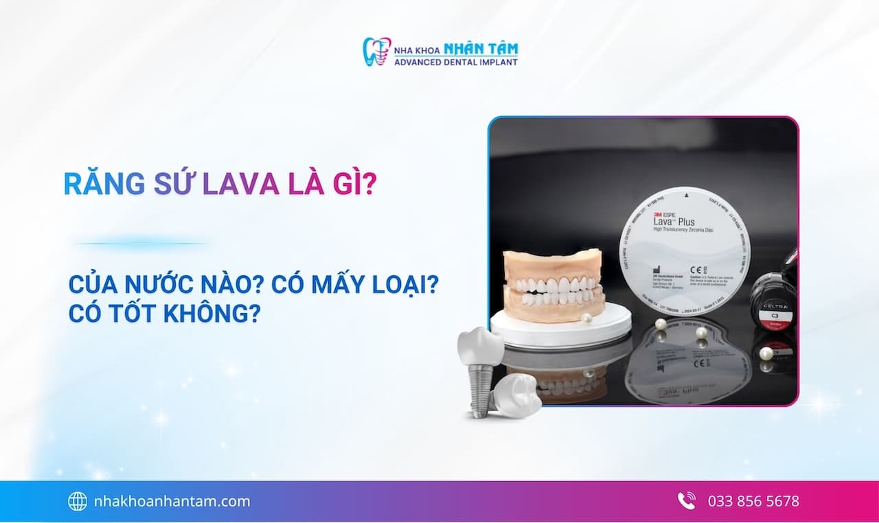 Răng sứ Lava là gì? Của nước nào? Có mấy loại? Tốt không? Giá bao nhiêu?