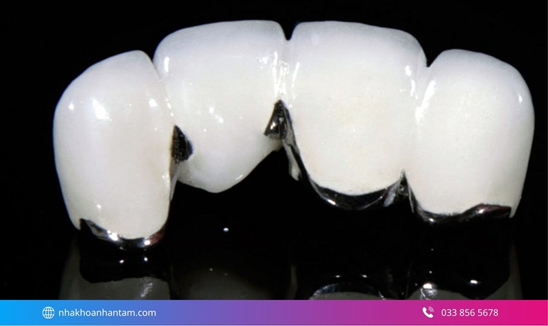 răng sứ nào an toàn cho sức khỏe