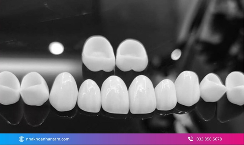 răng sứ nào ít bị đen viền