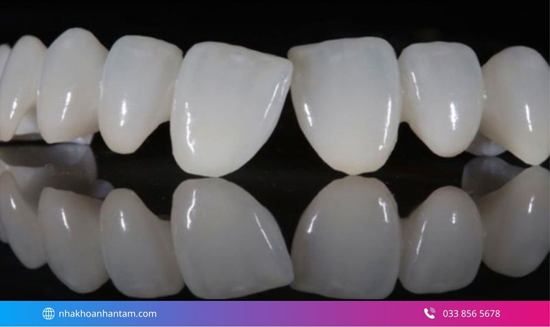 răng sứ nào tốt cho răng cửa