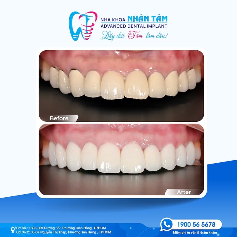 răng sứ trả góp không lãi suất