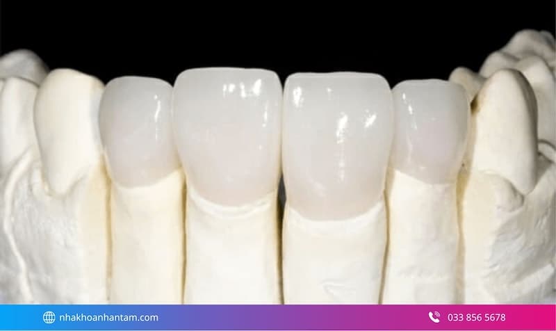 đánh giá răng sứ venus