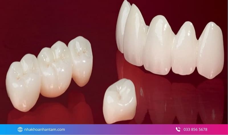 răng sứ venus có tốt không