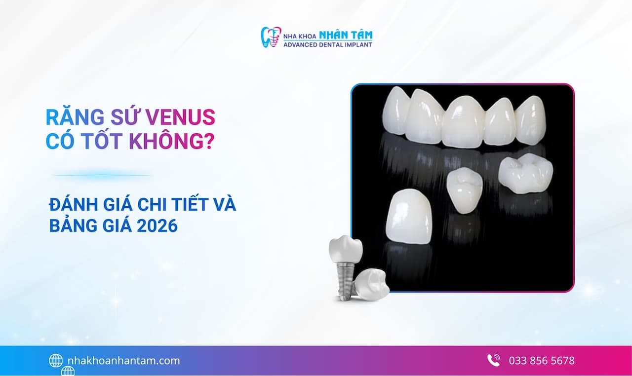 Răng sứ Venus có tốt không? Đánh giá chi tiết và bảng giá 2026
