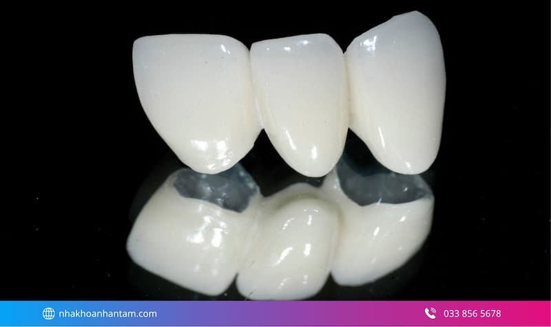 ưu điểm răng sứ venus