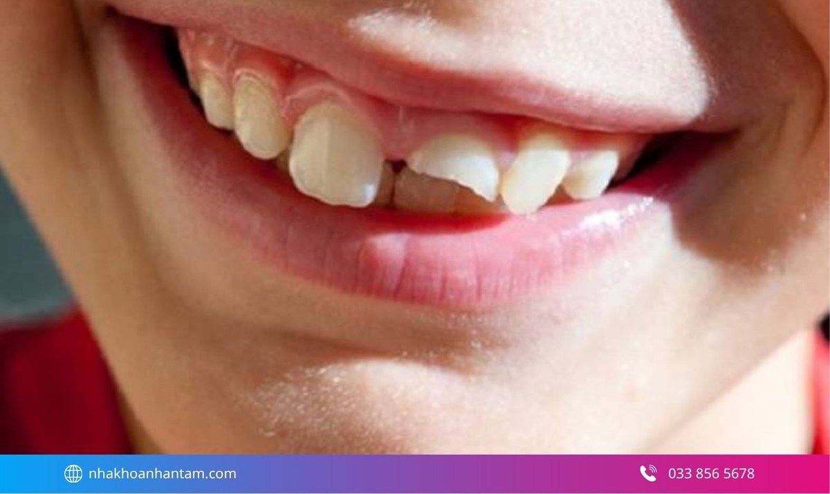 Hình: Răng sữa bị gãy và chỉ còn lại một phần thân răng