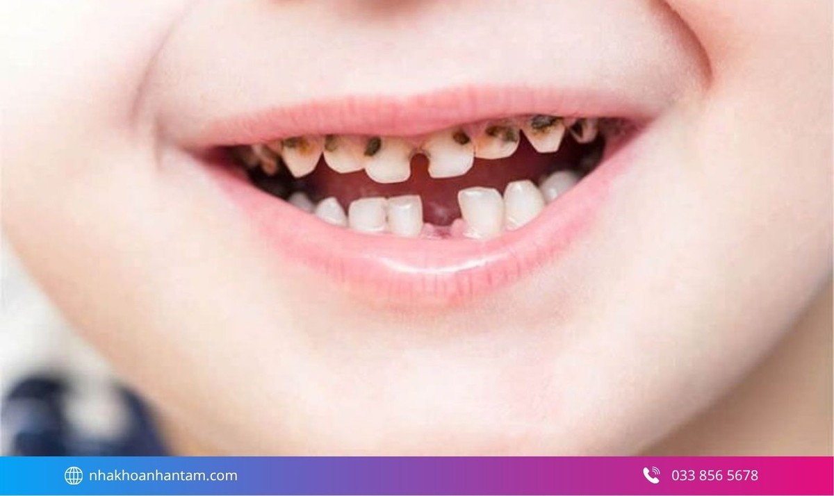 Hình: Răng sâu nhiều, vỡ lớn, gây đau hoặc không còn khả năng phục hồi