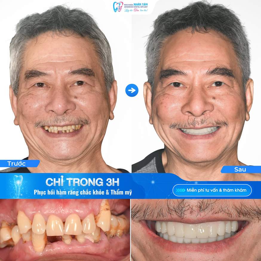Hình: Răng tạm giúp duy trì thẩm mỹ và ăn nhai nhẹ trong thời gian chờ tích hợp xương