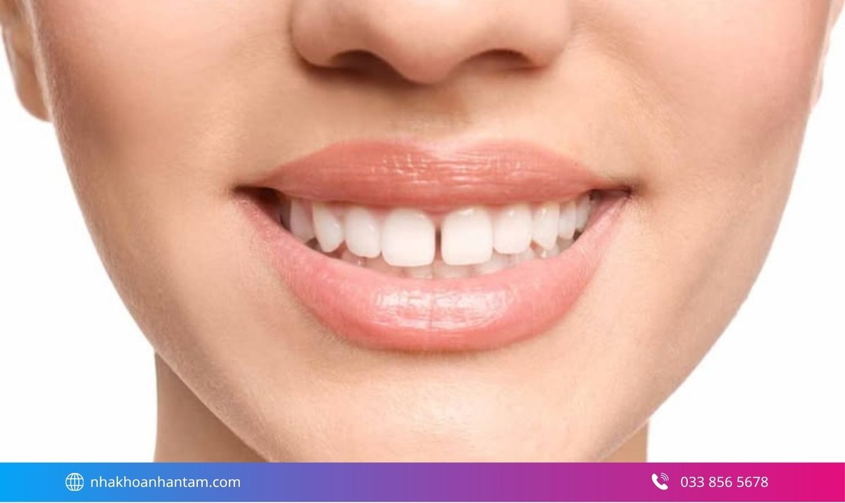 Răng thưa là tình trạng giữa các răng có khoảng hở rõ rệt, dễ thấy khi cười hoặc nói chuyện Hình: Răng thưa là tình trạng giữa các răng có khoảng hở rõ rệt, dễ thấy khi cười hoặc nói chuyện