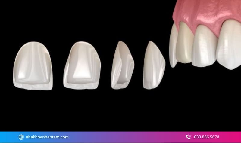 cảm nhận của người đã dán sứ