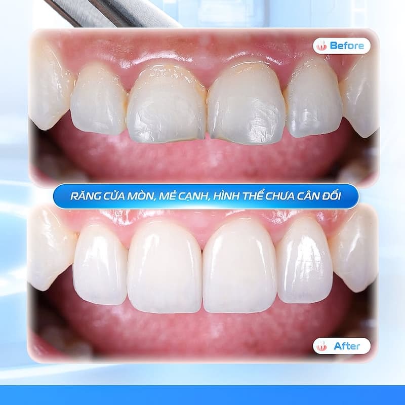 cảm nhận sau khi dán sứ