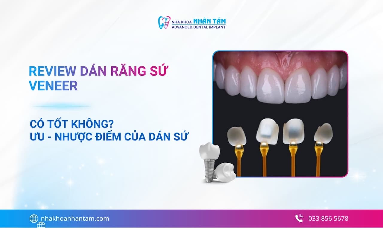 Review dán răng sứ Veneer: Có tốt không? Ưu - nhược điểm của dán sứ