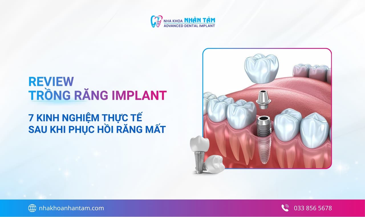 Hình: Review trồng răng Implant: Hiệu quả vượt trội giá cả hợp lý
