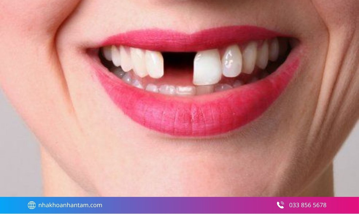 Hình: Những rủi ro có thể gặp khi nhổ răng cửa