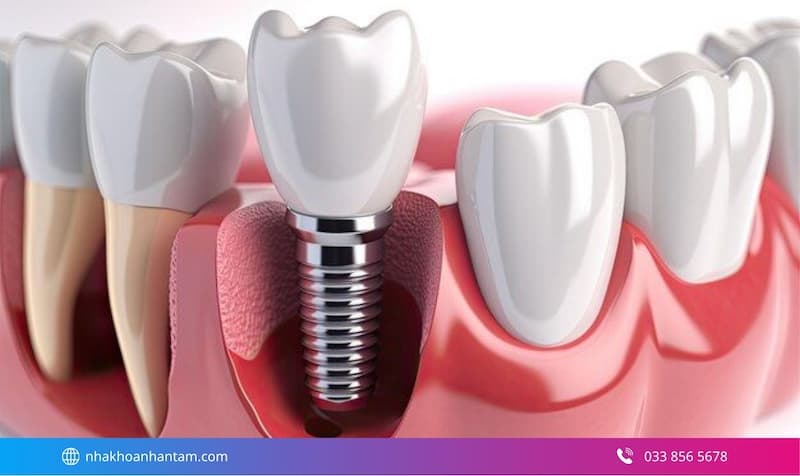 so sánh cầu răng sứ và implant
