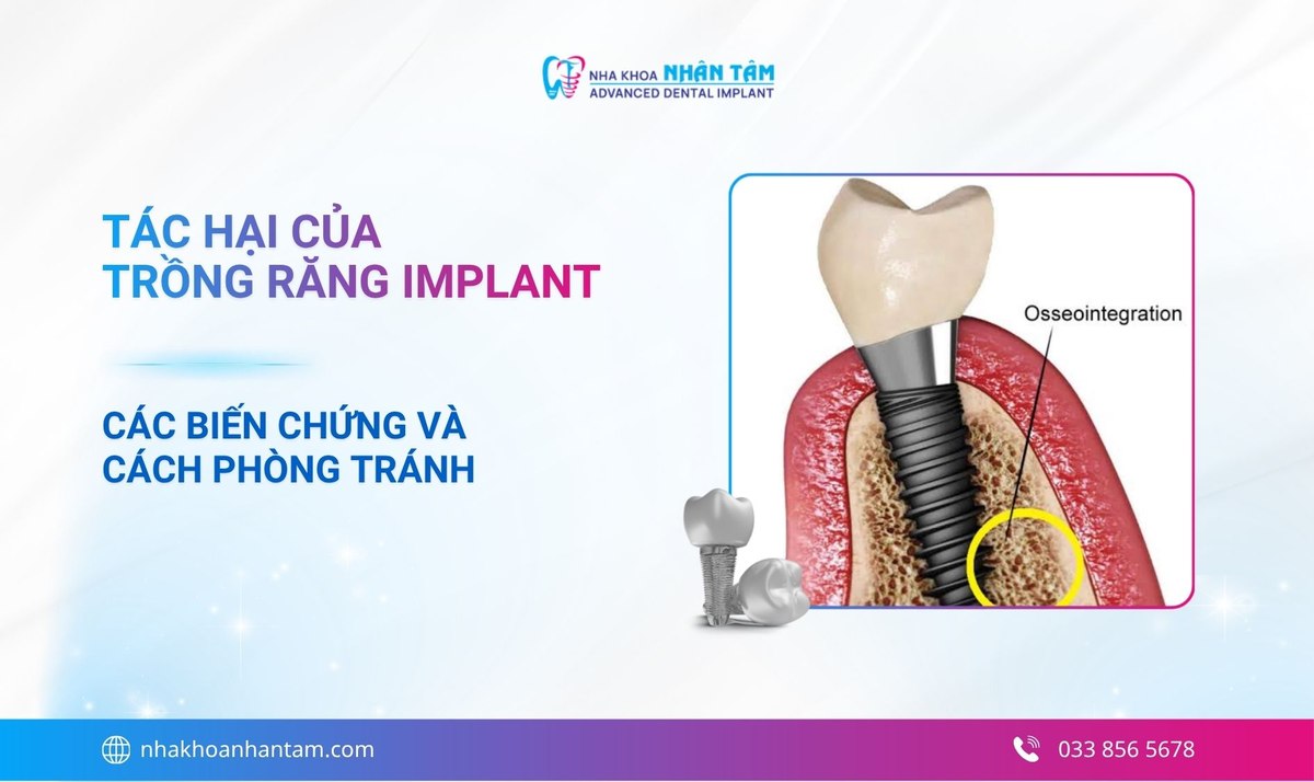 Tác hại của trồng răng implant: Các biến chứng và cách phòng tránh