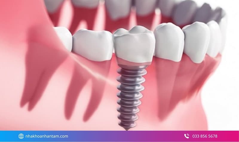 tại sao nên trồng răng implant