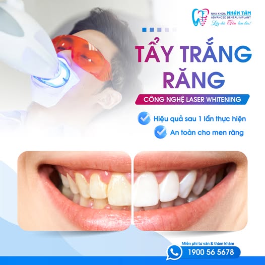 tẩy trắng răng cho răng nhiễm màu
