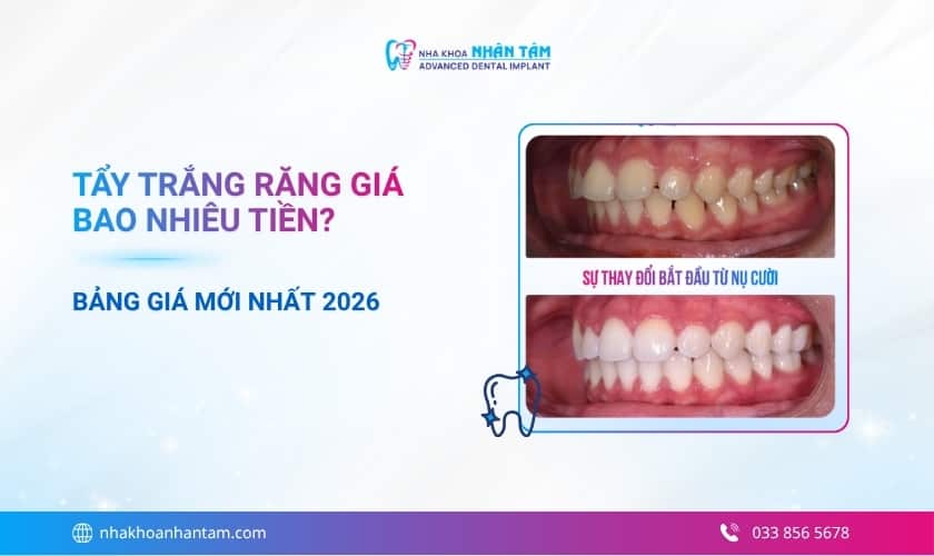 Tẩy trắng răng giá bao nhiêu tiền? Bảng giá mới nhất 2026