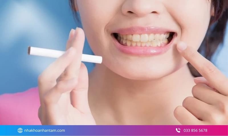 chi phí tẩy trắng răng