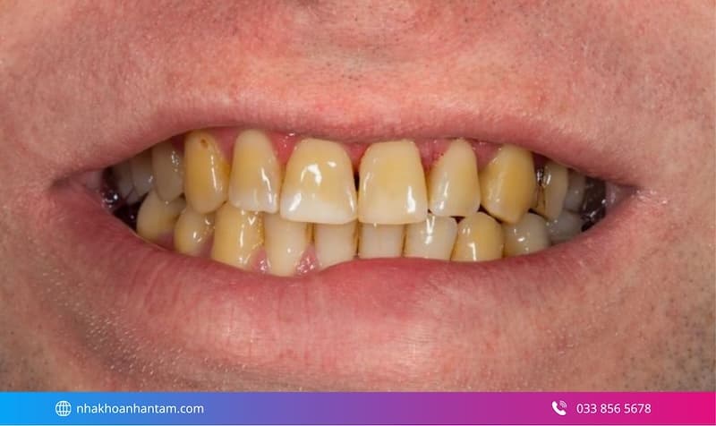 tẩy trắng răng công nghệ cao