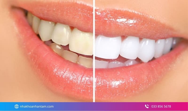 tẩy trắng răng laser