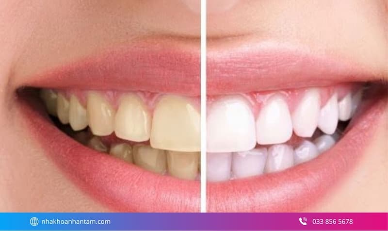 tẩy trắng răng tại nha khoa
