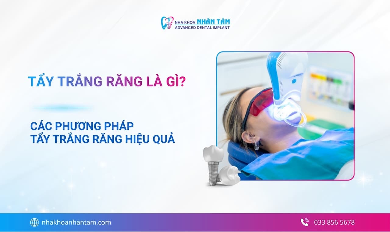 Tẩy trắng răng là gì? Các phương pháp tẩy trắng răng hiệu quả
