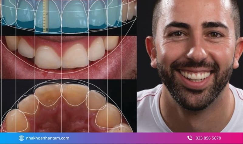 thẩm mỹ răng bằng sứ