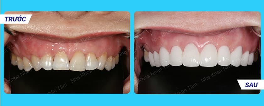 thẩm mỹ răng cửa bằng sứ