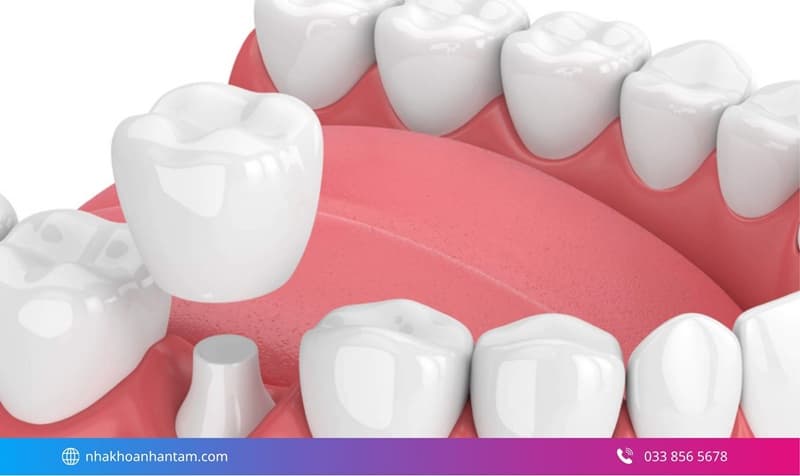 thẩm mỹ răng hiện đại bằng sứ