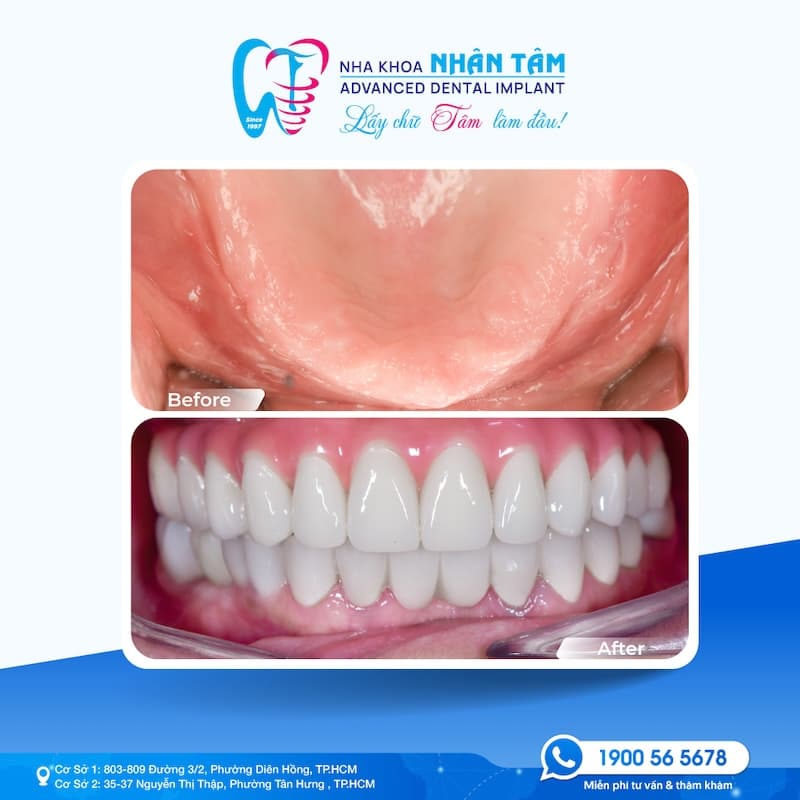 thời gian cấy ghép implant