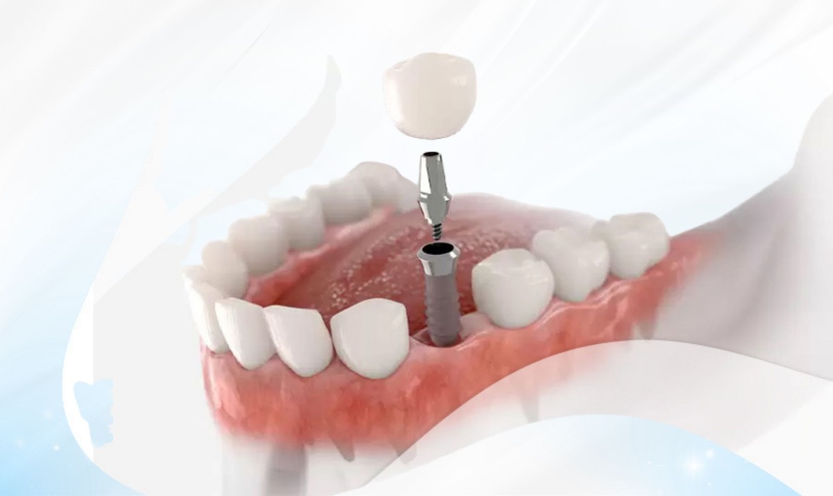 Hình: Thời gian chờ cấy trụ Implant phụ thuộc vào tốc độ tích hợp xương ghép và kỹ thuật nâng xoang được chỉ định