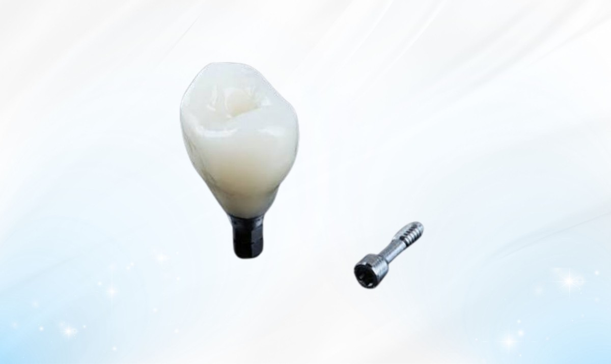 Hình: Răng tạm được sử dụng từ vài tuần đến vài tháng cho đến khi trụ implant tích hợp hoàn toàn với xương hàm