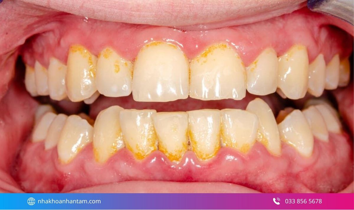 Thức ăn và mảng bám mắc quanh mặt dán là nguyên nhân gây hôi miệng Hình: Thức ăn và mảng bám mắc quanh mặt dán là nguyên nhân gây hôi miệng