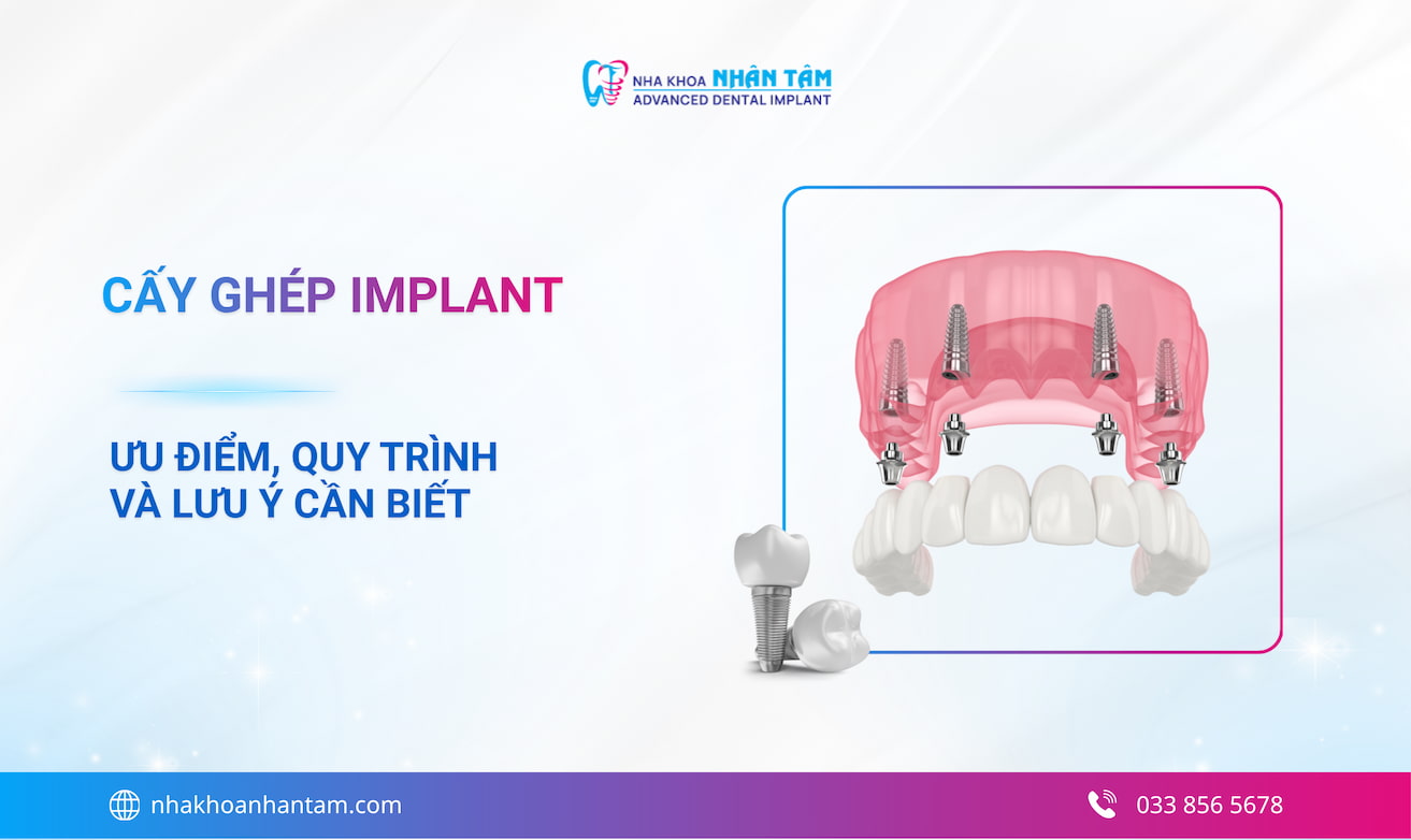 Hình: Cấy ghép răng Implant là gì? Ưu nhược điểm phương pháp cấy ghép Implant