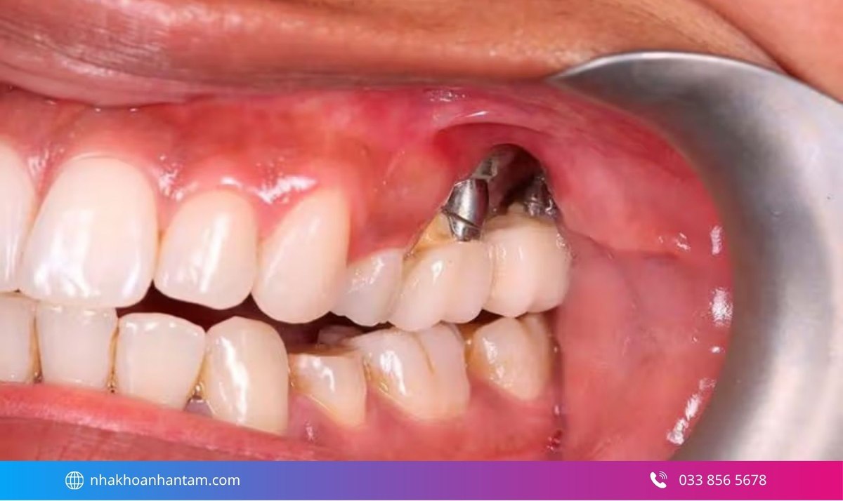 Hình: Có thể xảy ra biến chứng tiêu xương quanh cổ implant