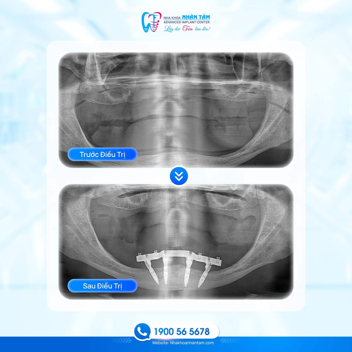 Hình: Tình trạng xương hàm là yếu tố quan trọng quyết định thời gian tích hợp của trụ Implant