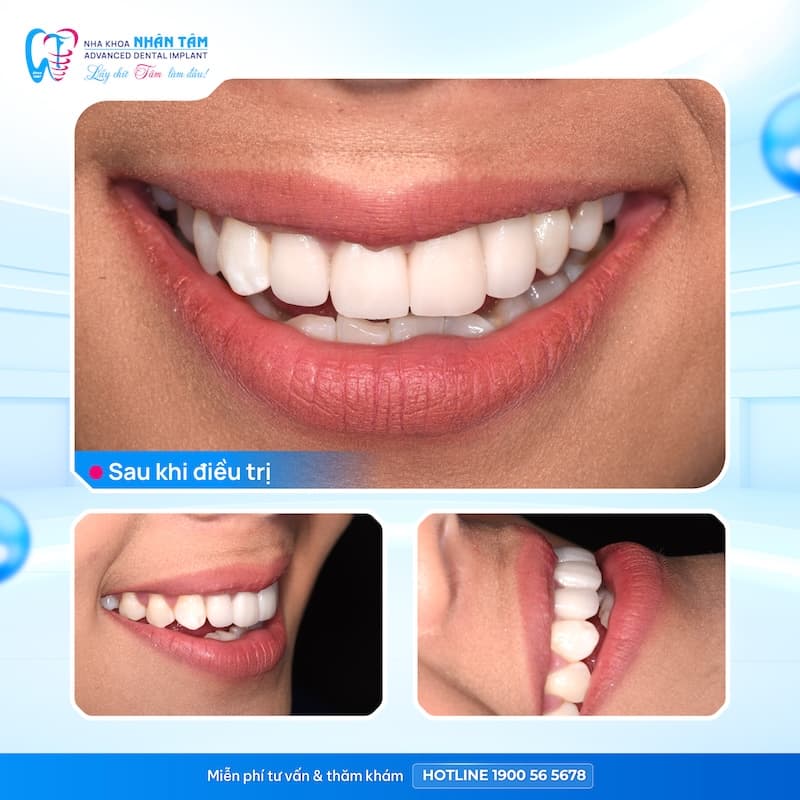 trả góp răng sứ thẩm mỹ