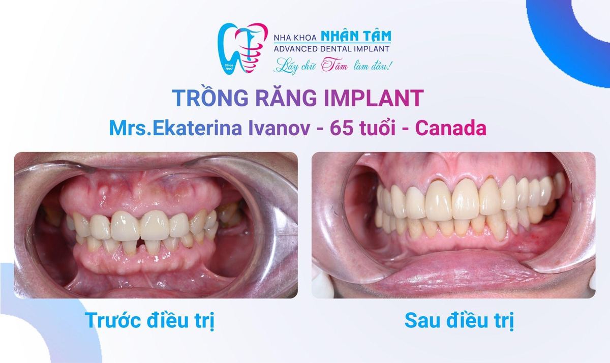 Hình: Cô Ekaterina Ivanov (Canada) – Câu chuyện khách hàng tại Nha khoa Nhân Tâm