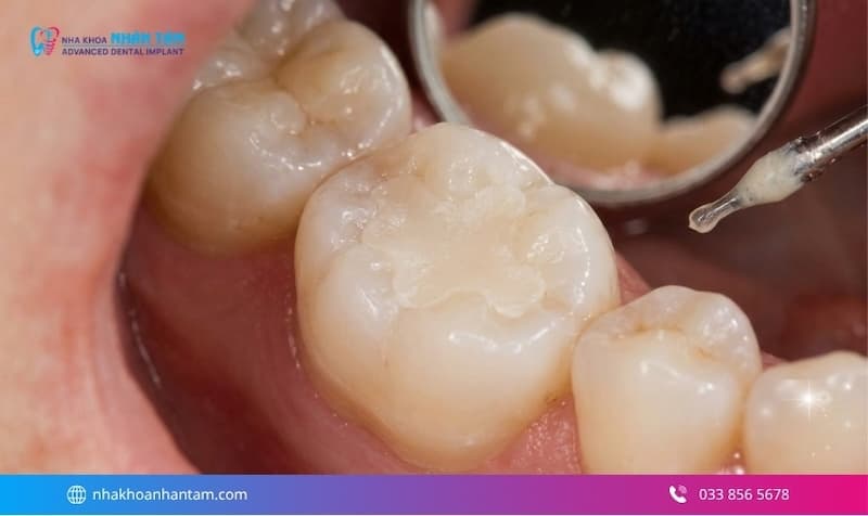 trám răng bị mẻ