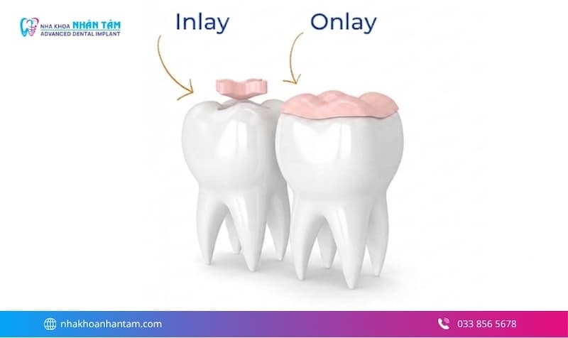 trám răng cho trẻ em