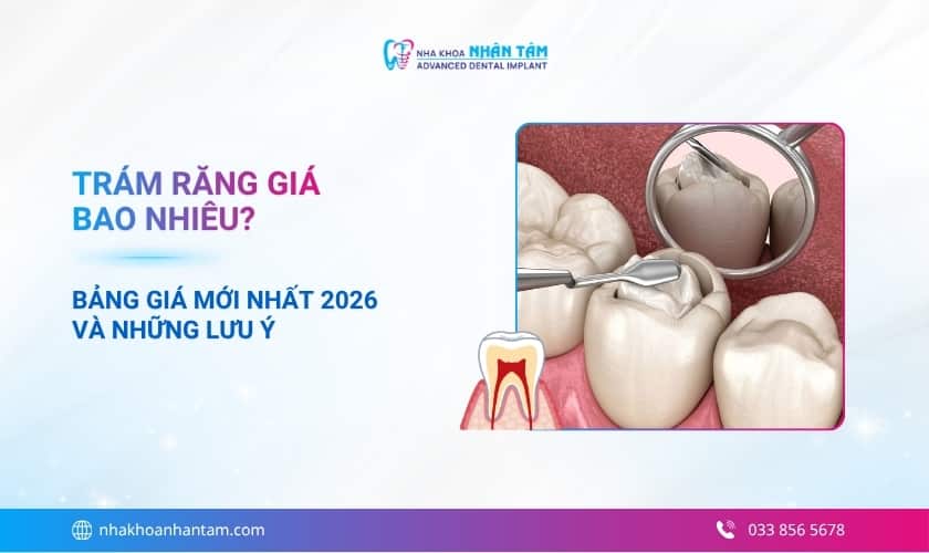 Trám răng giá bao nhiêu? Bảng giá mới nhất 2026 và những lưu ý 