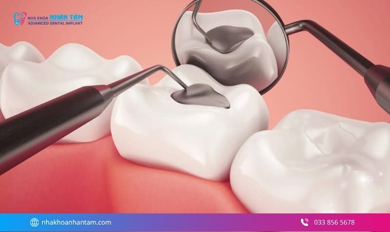 trám răng giữ được bao lâu